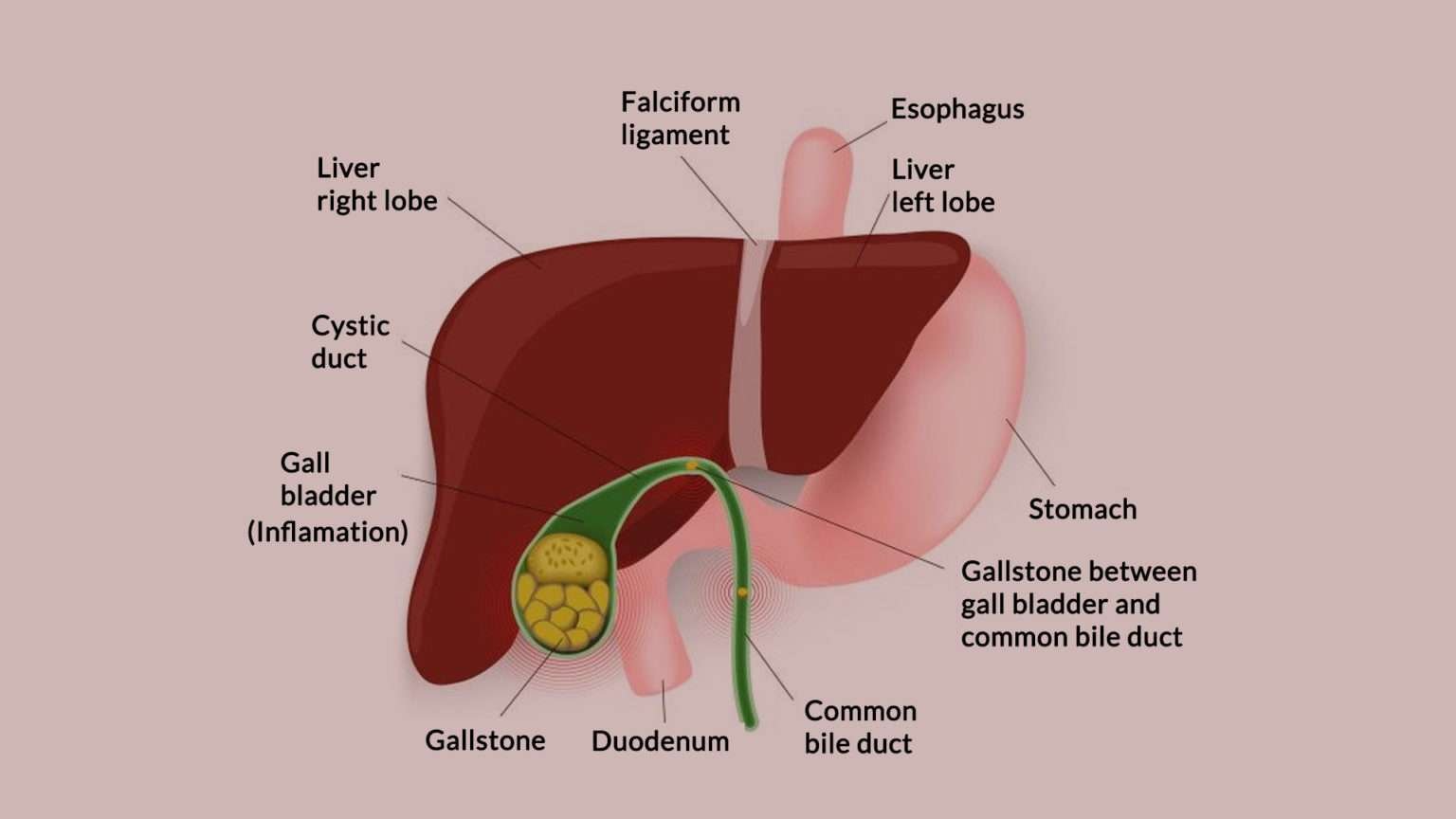 Cholecystitis  Symptoms, Causes and Complications  NutritionFact.in